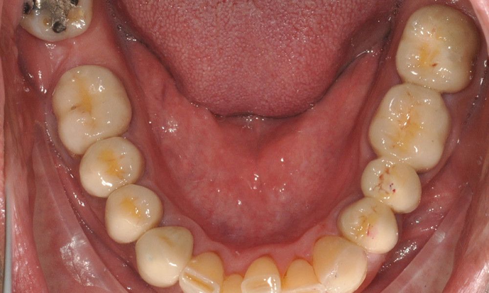Rehabilitacion-oral10