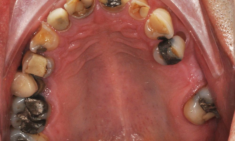 Rehabilitacion-oral4