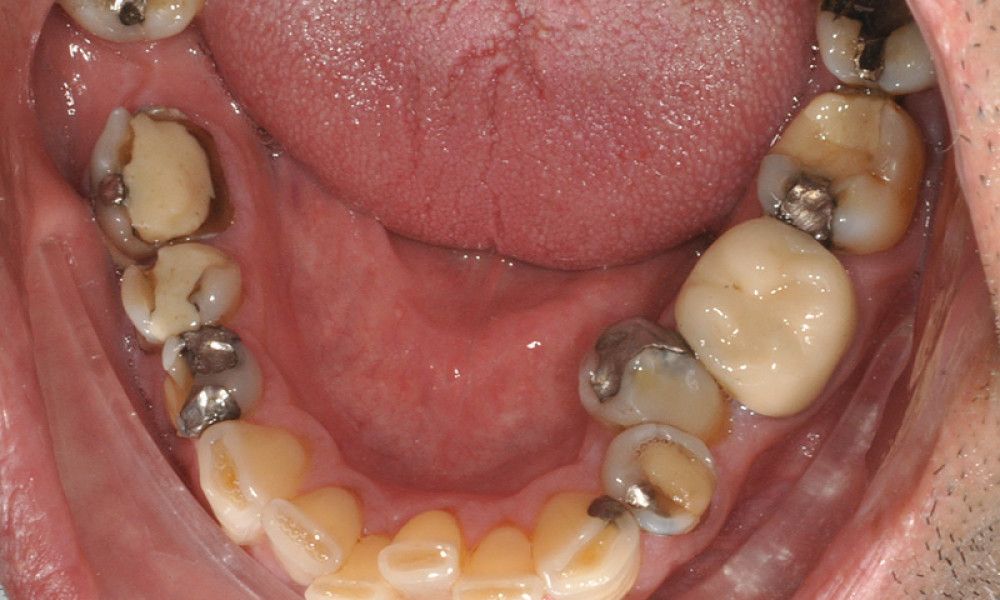 Rehabilitacion-oral5