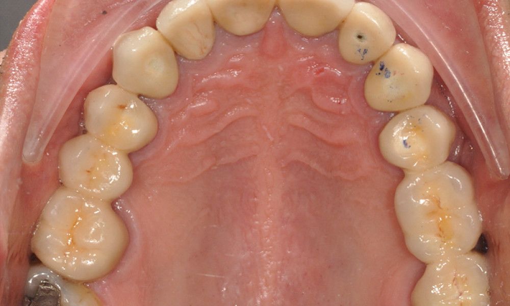 Rehabilitacion-oral9