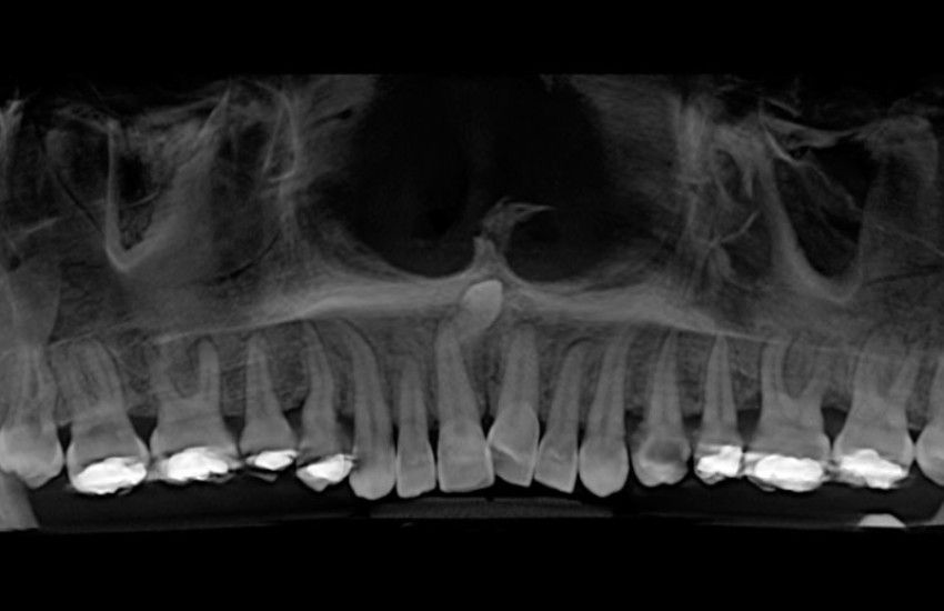 exodoncia_mesiodens5