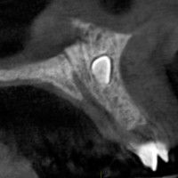 exodoncia_mesiodens6