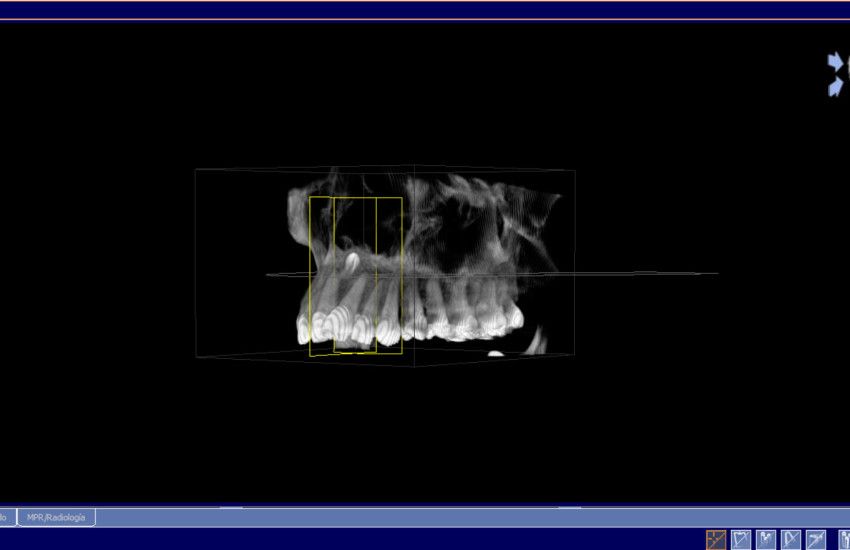exodoncia_mesiodens7