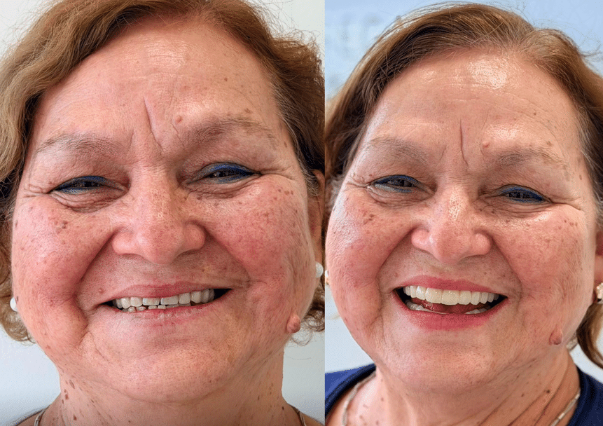 María Elena antes y después de su rehabilitación oral